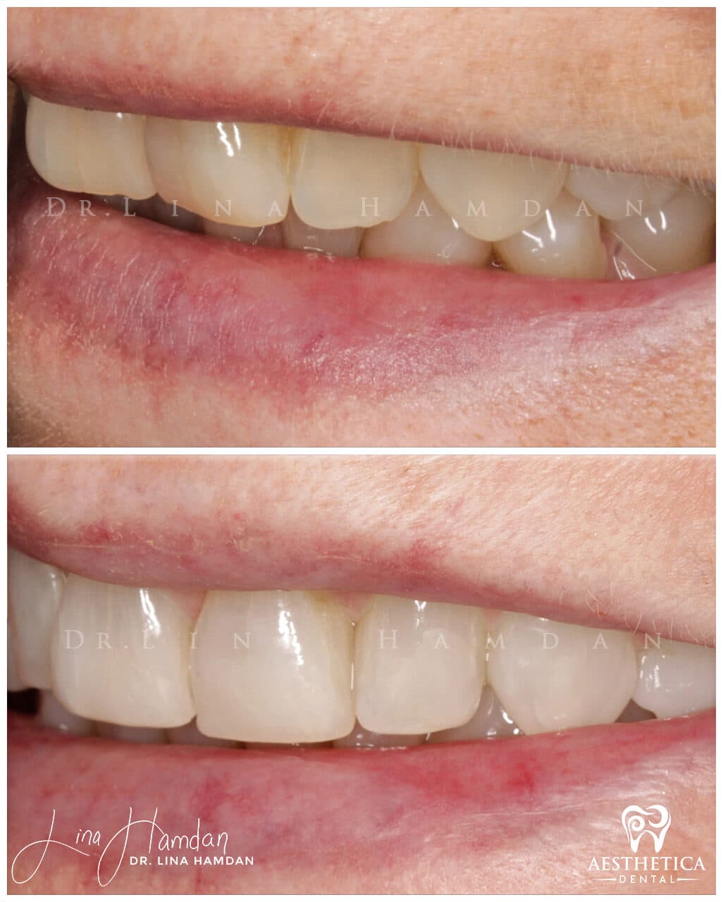 Inman aligners: anonymous case 32 from Aesthetica Dental Naperville