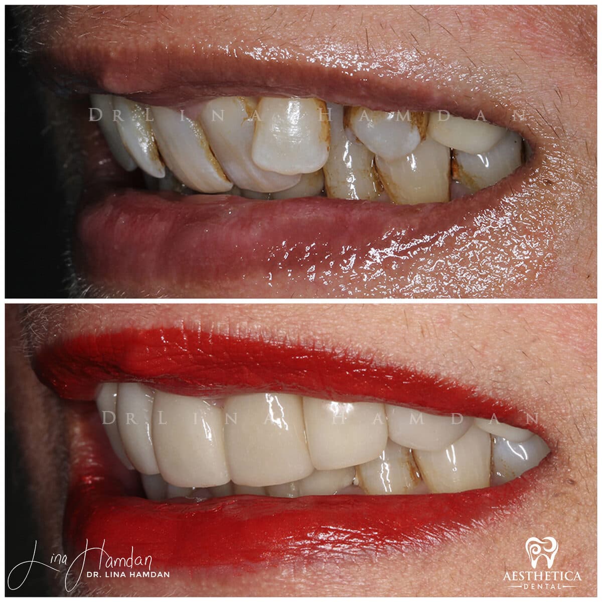 Inman aligners: anonymous case 35 from Aesthetica Dental Naperville