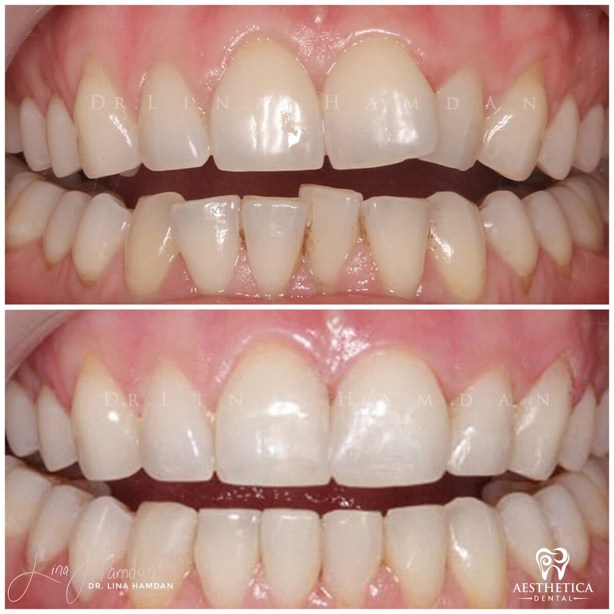 Inman aligners: anonymous case 37 from Aesthetica Dental Naperville