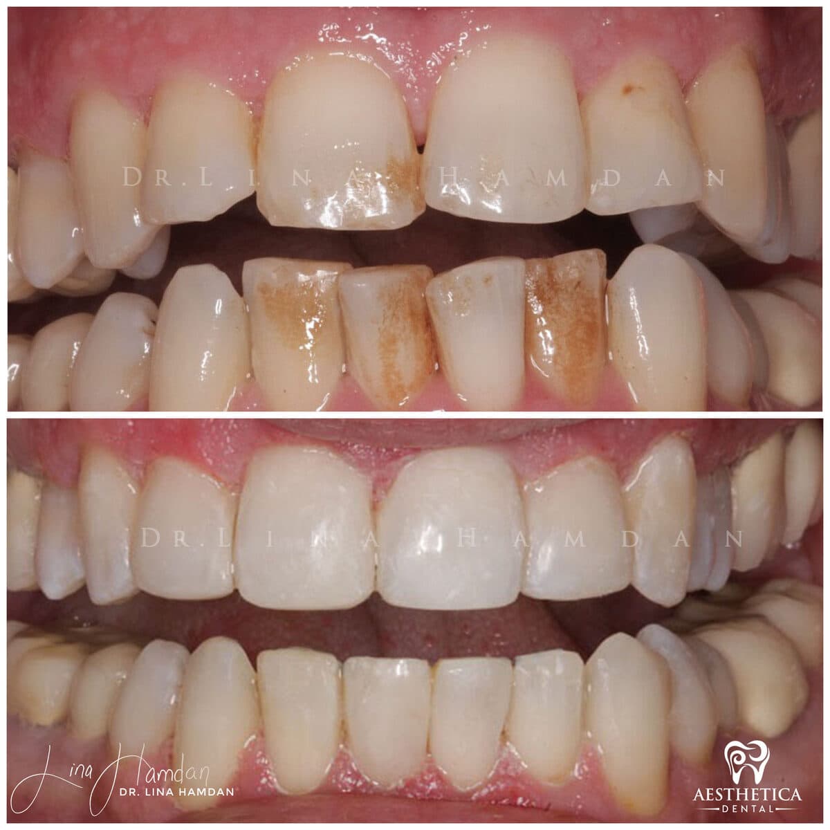 Inman aligners: anonymous case 38 from Aesthetica Dental Naperville