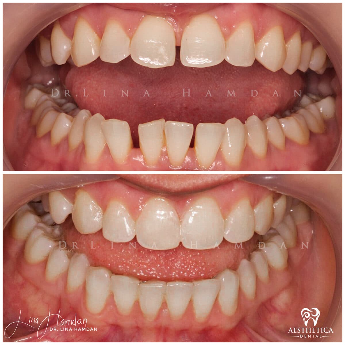 Inman aligners: anonymous case 39 from Aesthetica Dental Naperville