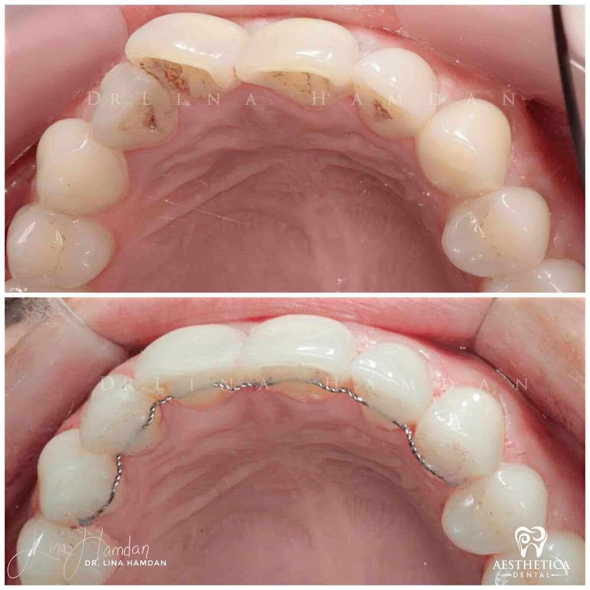Inman aligners: anonymous case 43 from Aesthetica Dental Naperville