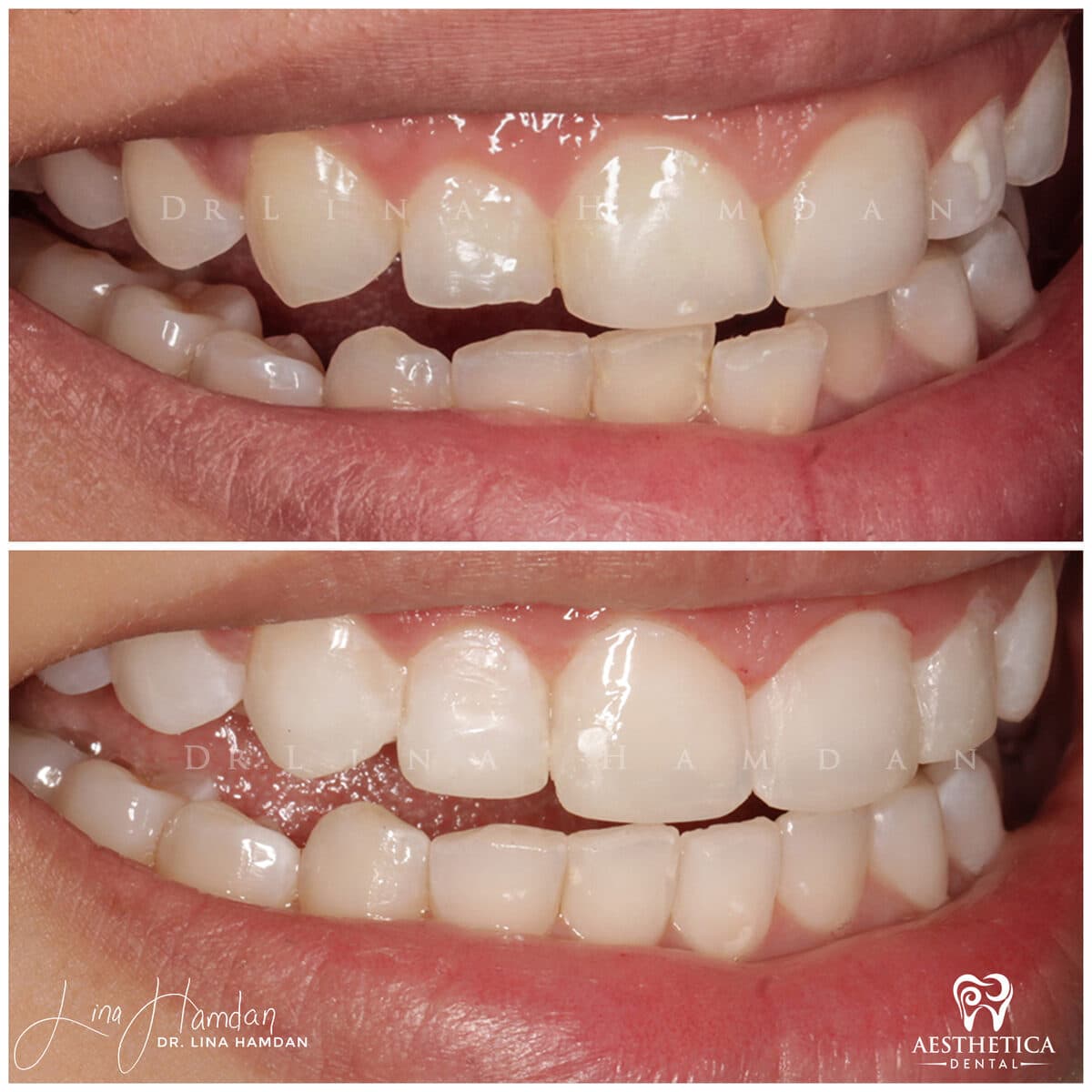 Inman aligners: anonymous case 44 from Aesthetica Dental Naperville