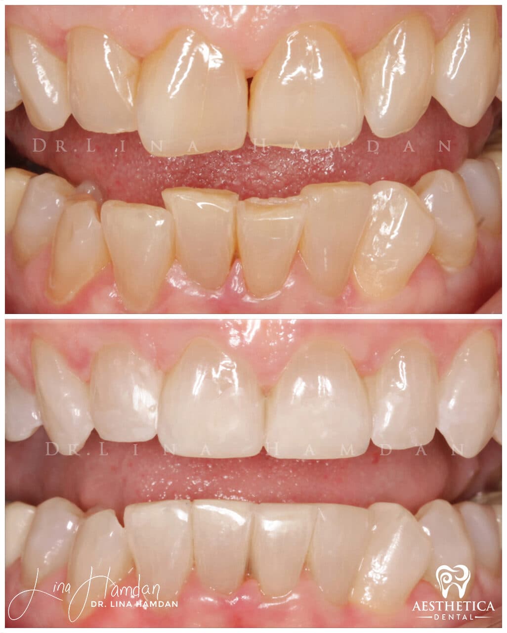 Inman aligners: anonymous case 46 from Aesthetica Dental Naperville