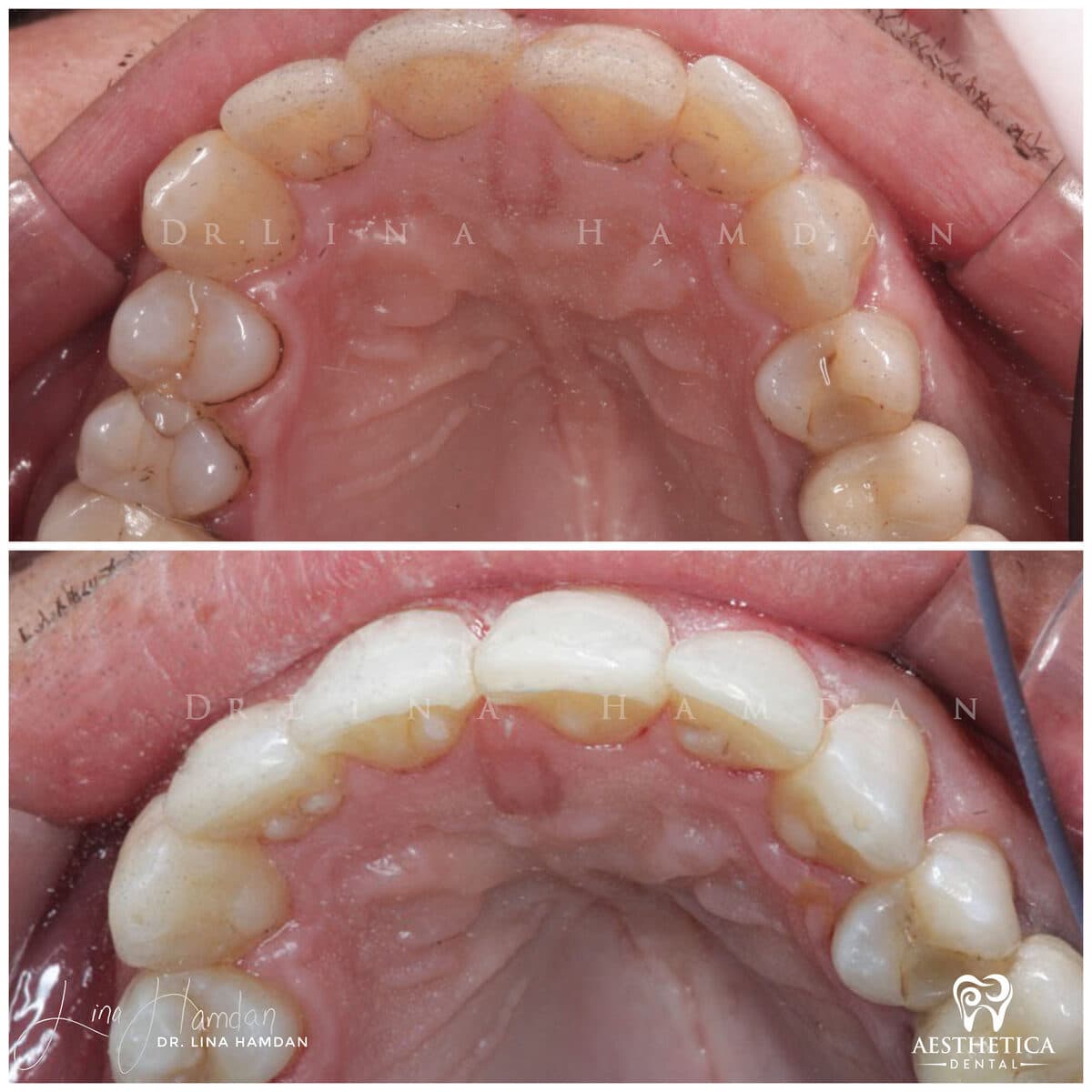 Inman aligners: anonymous case 47 from Aesthetica Dental Naperville