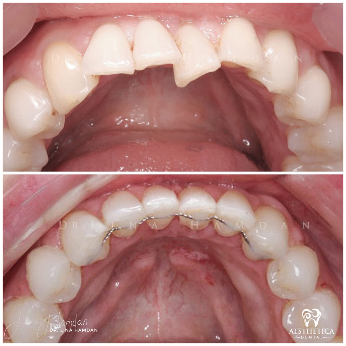 Inman aligners: anonymous case 50 from Aesthetica Dental Naperville
