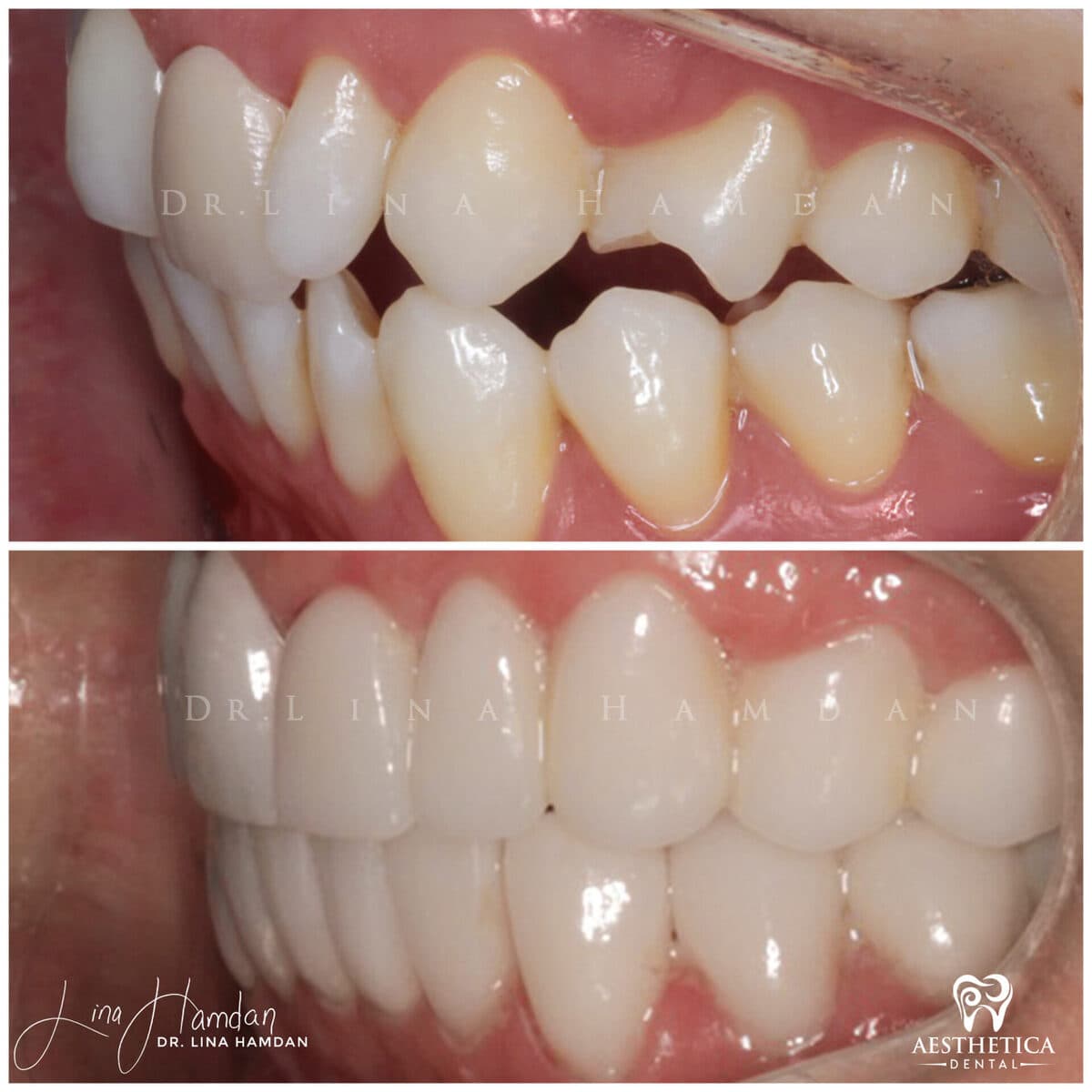 Inman aligners: anonymous case 52 from Aesthetica Dental Naperville