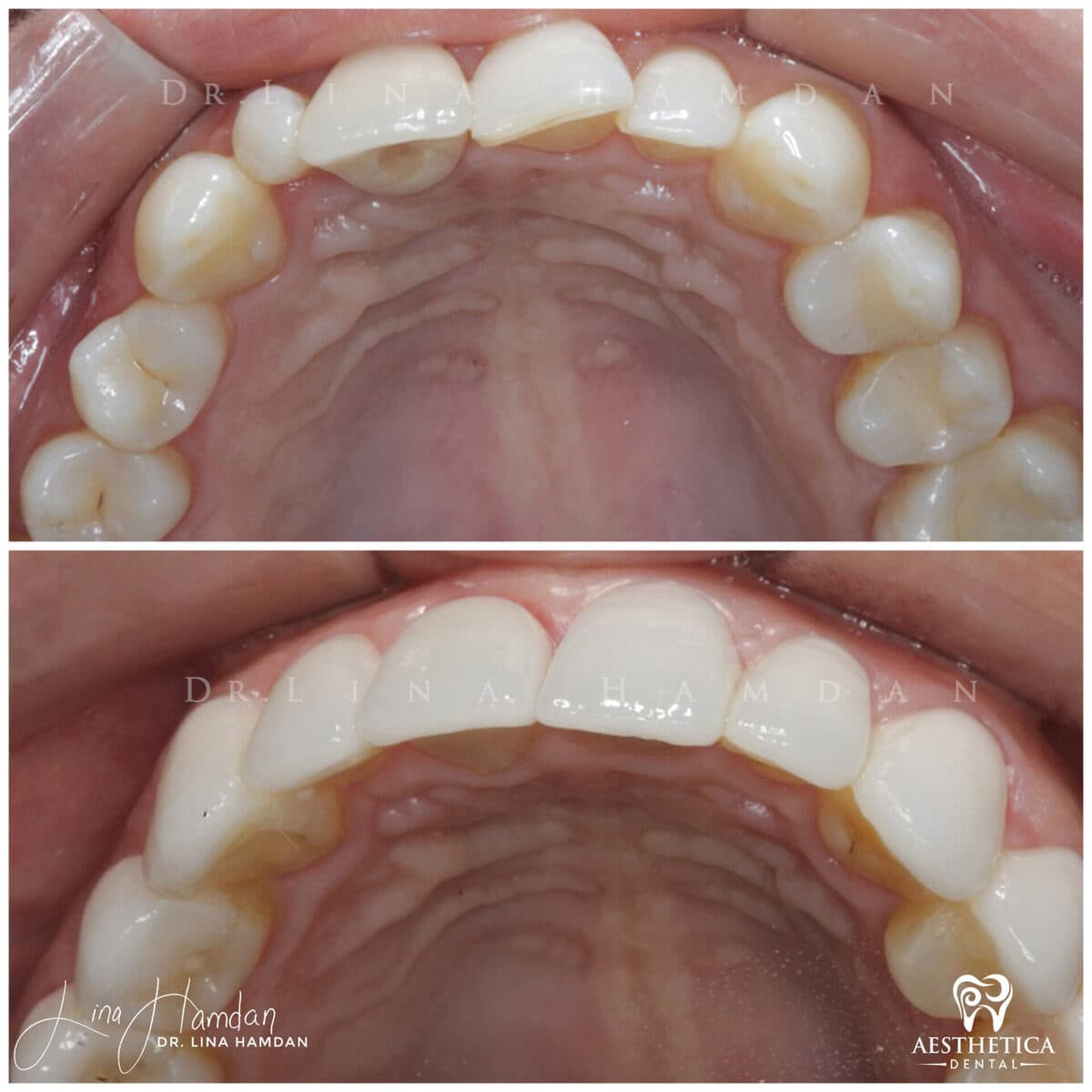 Inman aligners: anonymous case 53 from Aesthetica Dental Naperville