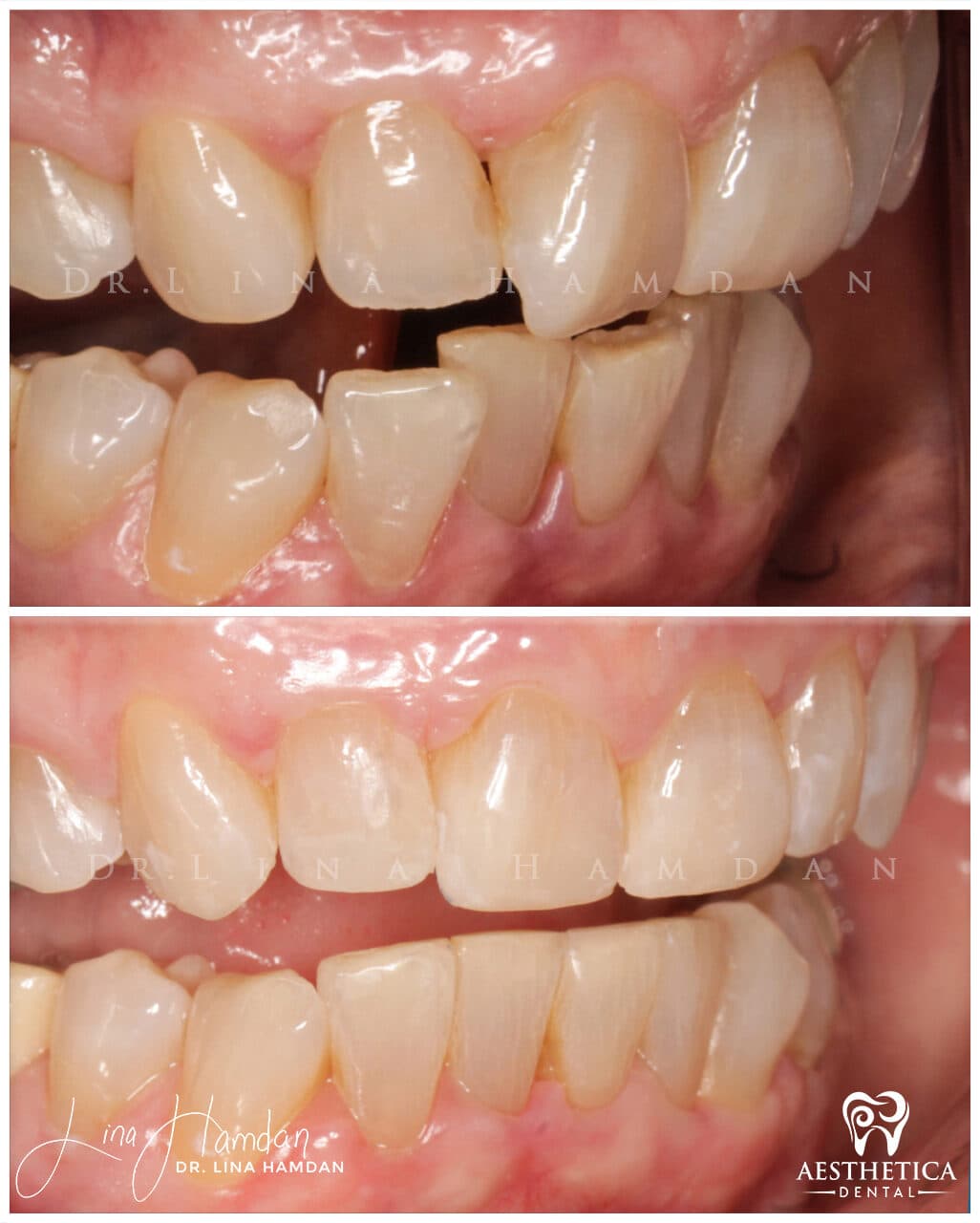 Inman aligners: anonymous case 54 from Aesthetica Dental Naperville