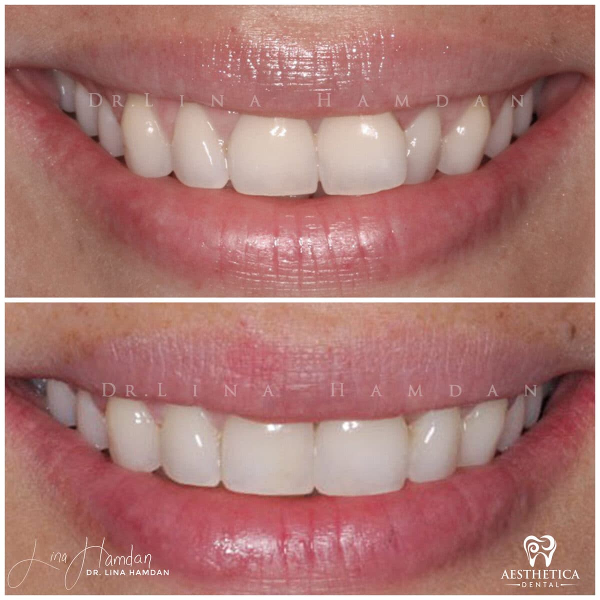 Inman aligners: anonymous case 55 from Aesthetica Dental Naperville