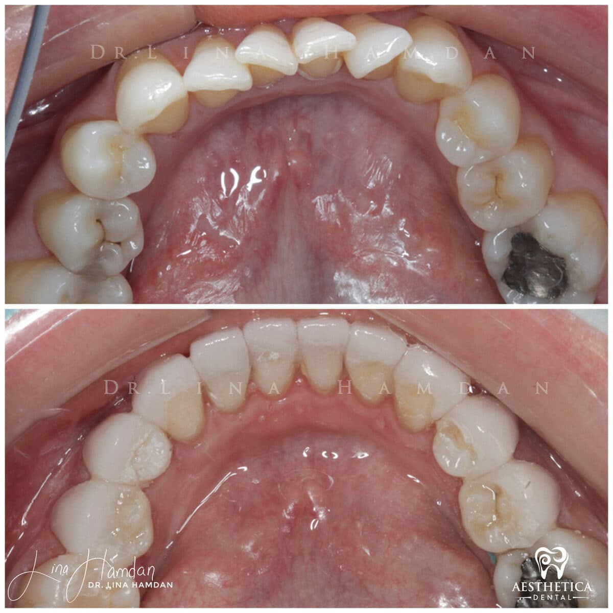 Inman aligners: anonymous case 56 from Aesthetica Dental Naperville