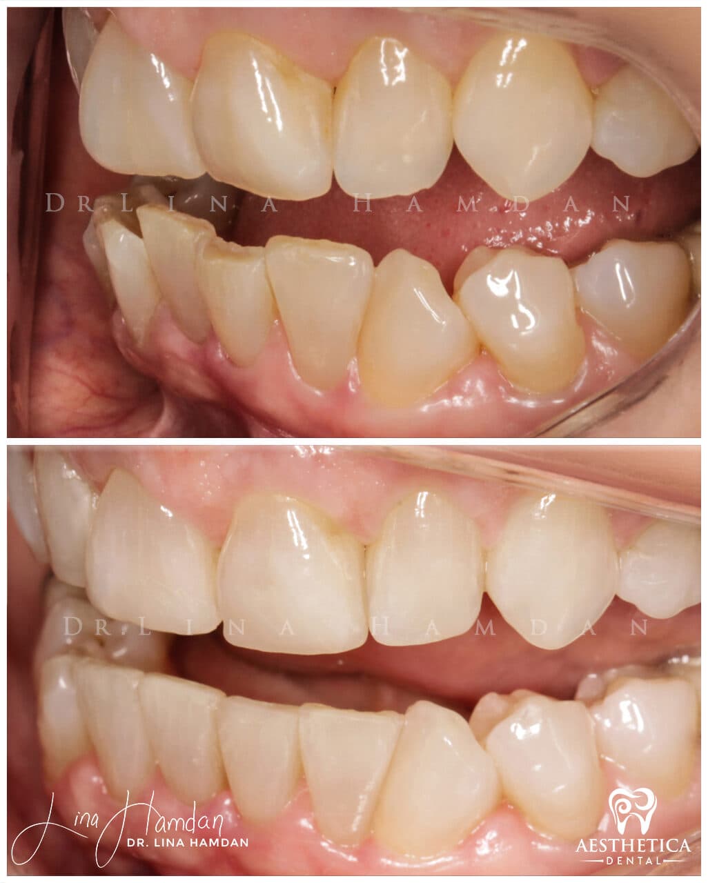 Inman aligners: anonymous case 60 from Aesthetica Dental Naperville