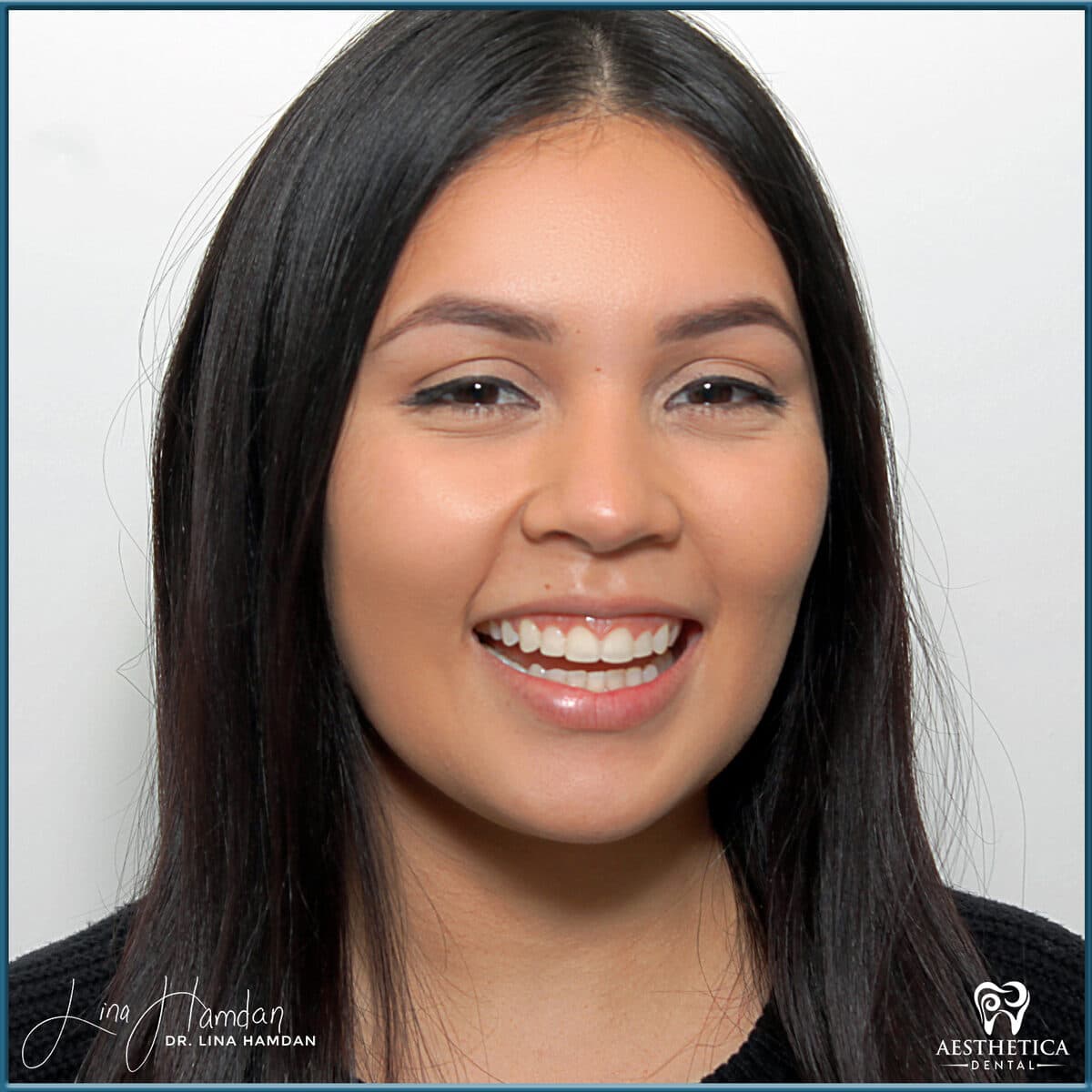 Inman aligners: anonymous case 62 from Aesthetica Dental Naperville