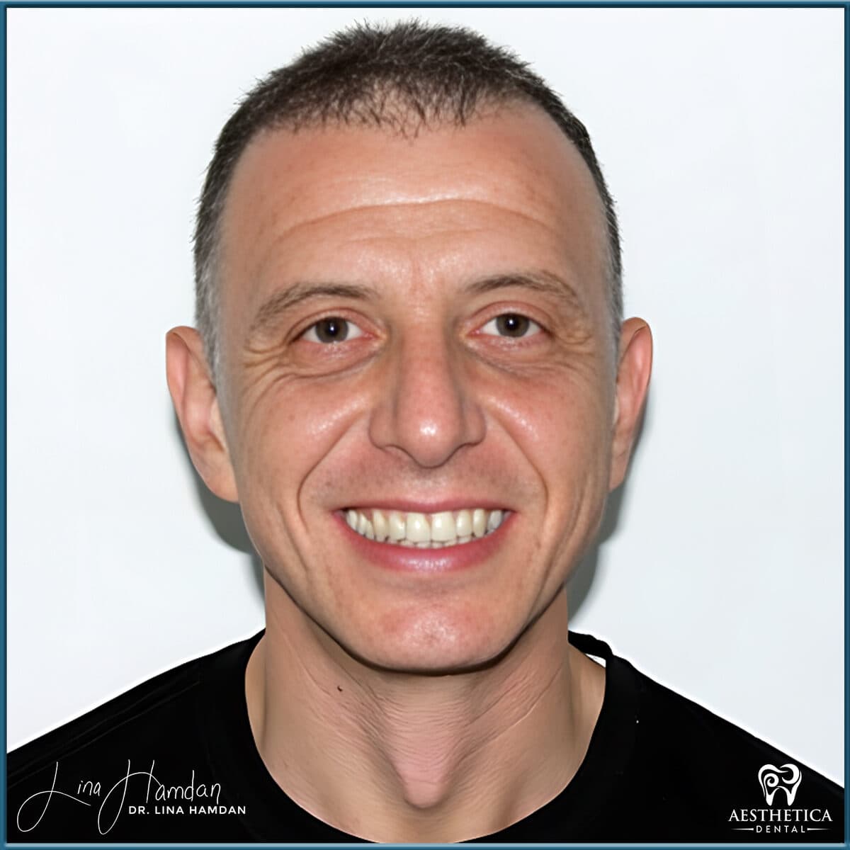 Inman aligners: anonymous case 65 from Aesthetica Dental Naperville