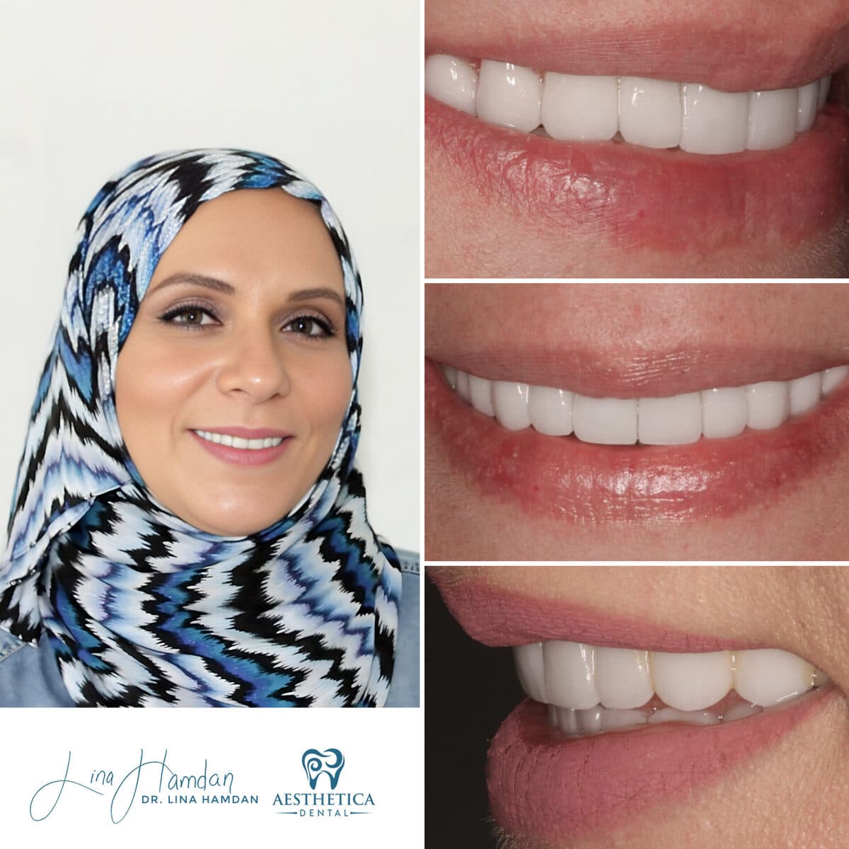 Inman aligners: anonymous case 73 from Aesthetica Dental Naperville