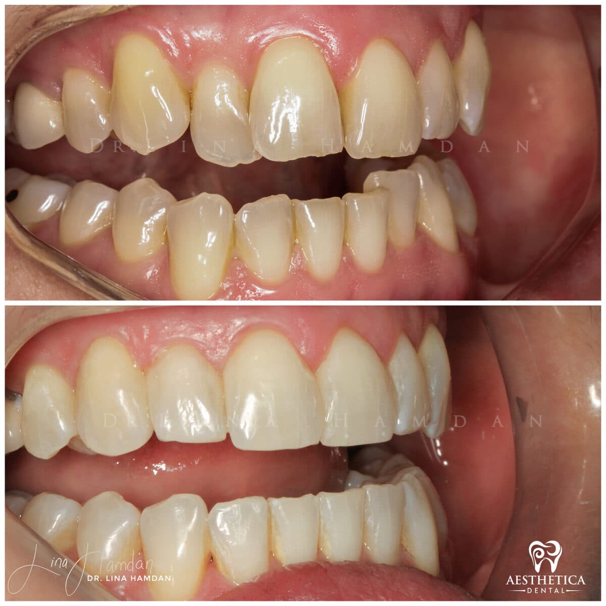 Invisalign clear aligner result, anonymous patient at Aesthetica Dental Naperville (case 6, 2025-01-13-4)