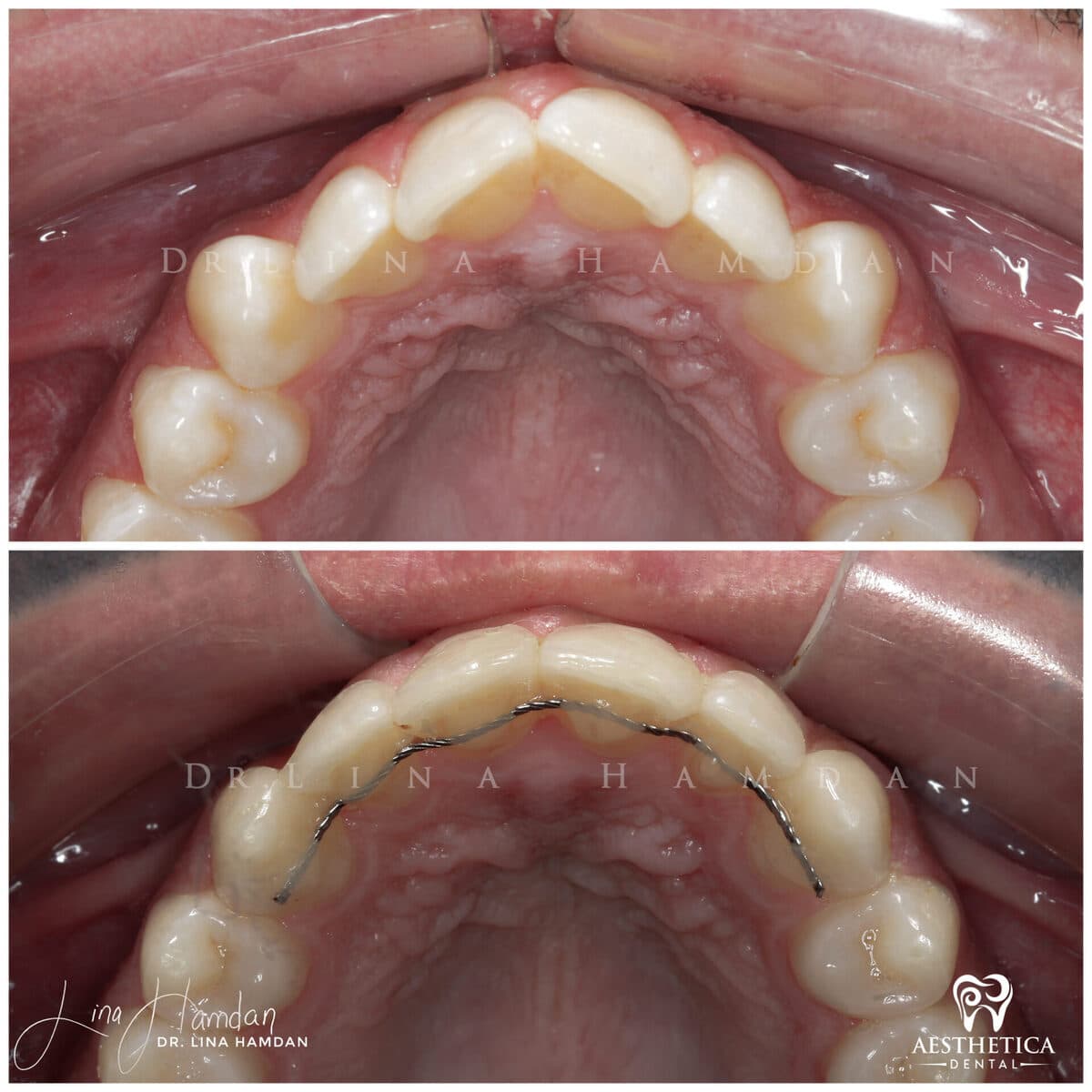 Invisalign clear aligner result, anonymous patient at Aesthetica Dental Naperville (case 11, 2025-01-17-3)