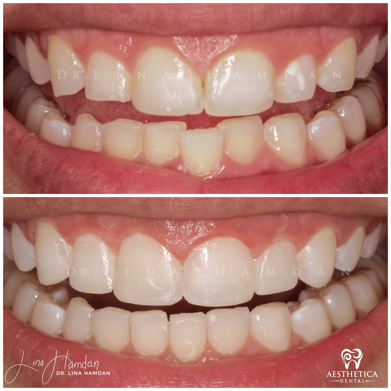 Smile makeover before and after, anonymous patient at Dr. Lina Hamdan Naperville (case 6, 2025-01-2-4)