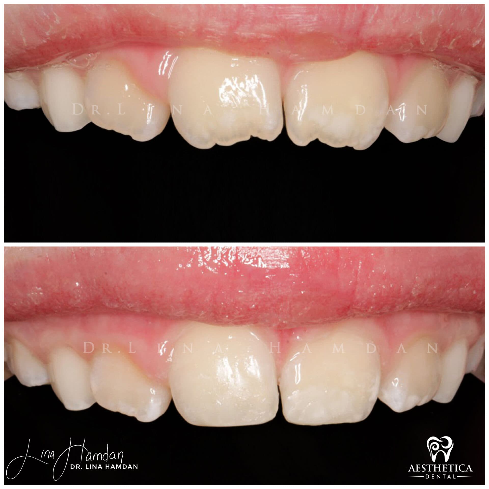 Smile makeover before and after, anonymous patient at Dr. Lina Hamdan Naperville (case 8, 2025-01-3-39)