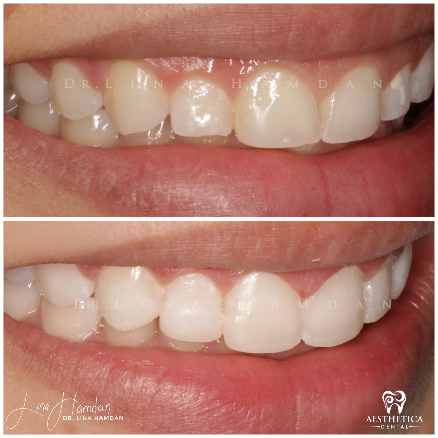 Smile makeover before and after, anonymous patient at Dr. Lina Hamdan Naperville (case 9, 2025-01-3-4)
