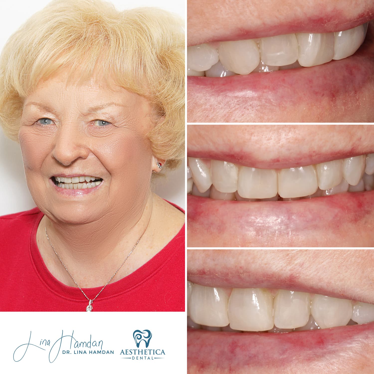 A full re-design of the smile: anonymous case 28 from Aesthetica Dental Naperville
