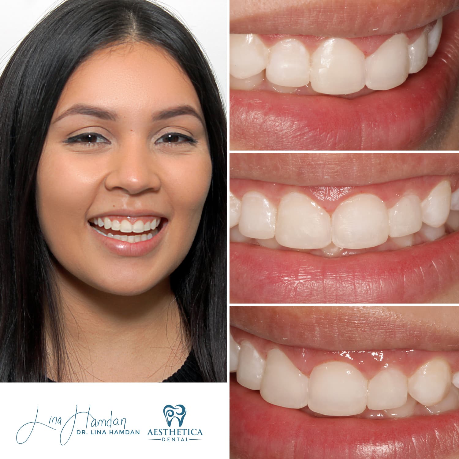 A full re-design of the smile: anonymous case 30 from Aesthetica Dental Naperville