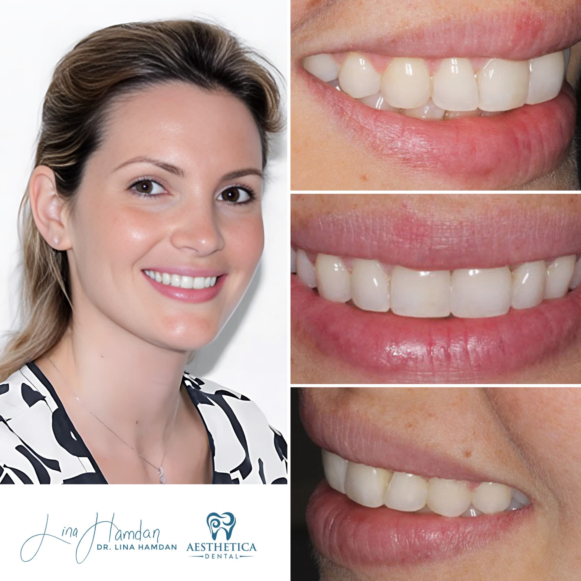 A full re-design of the smile: anonymous case 34 from Aesthetica Dental Naperville