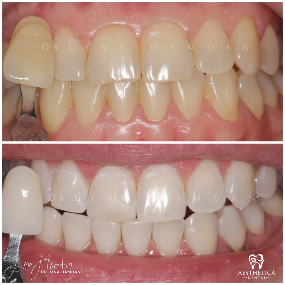 Teeth whitening case 10, anonymous patient at Aesthetica Dental Naperville, photo 2
