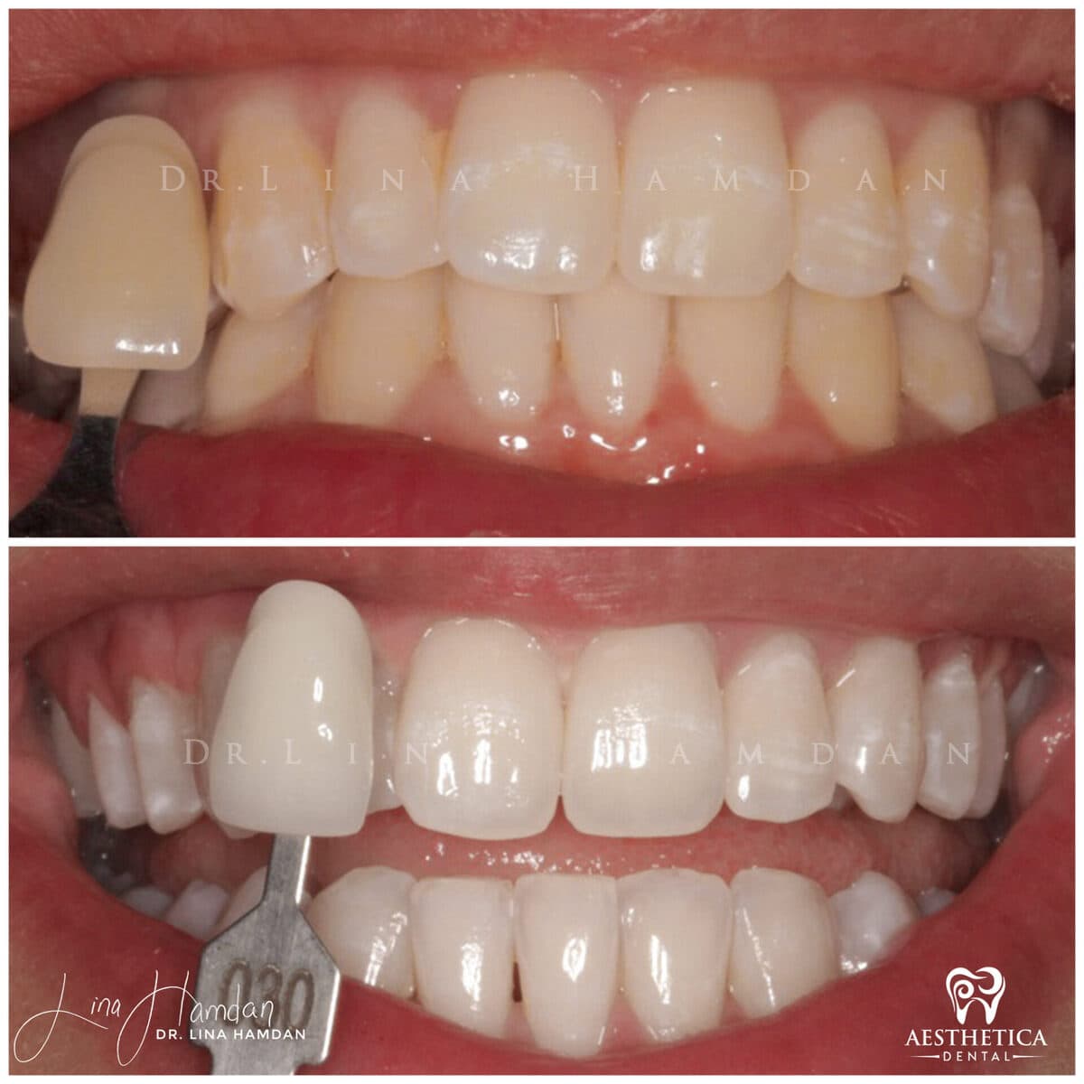 Teeth whitening case 9, anonymous patient at Aesthetica Dental Naperville, photo 2