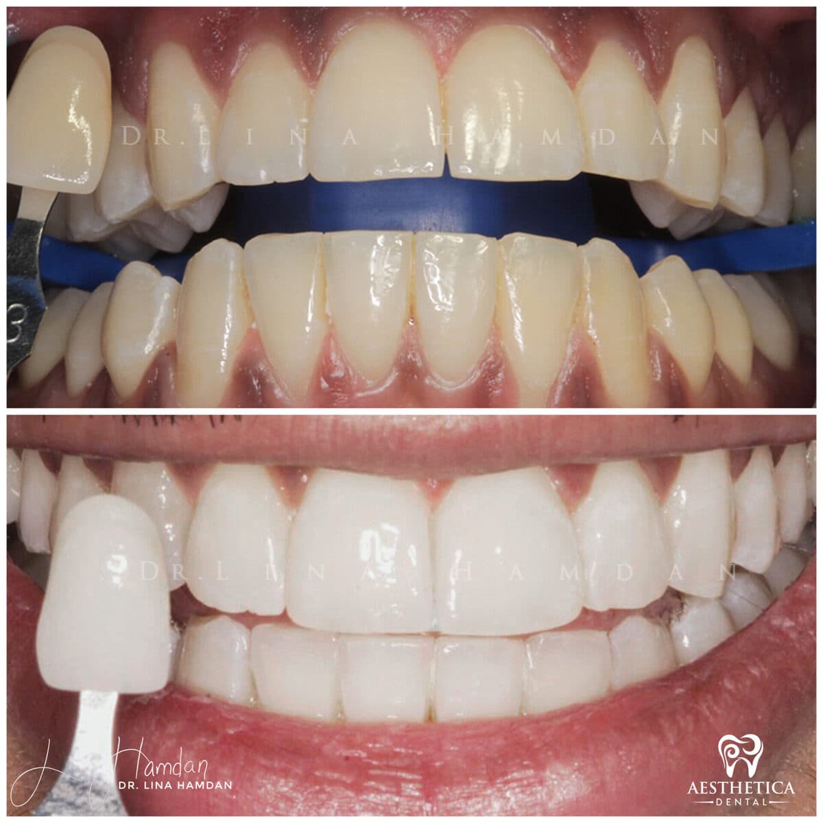 Teeth whitening case 7, anonymous patient at Aesthetica Dental Naperville, photo 2