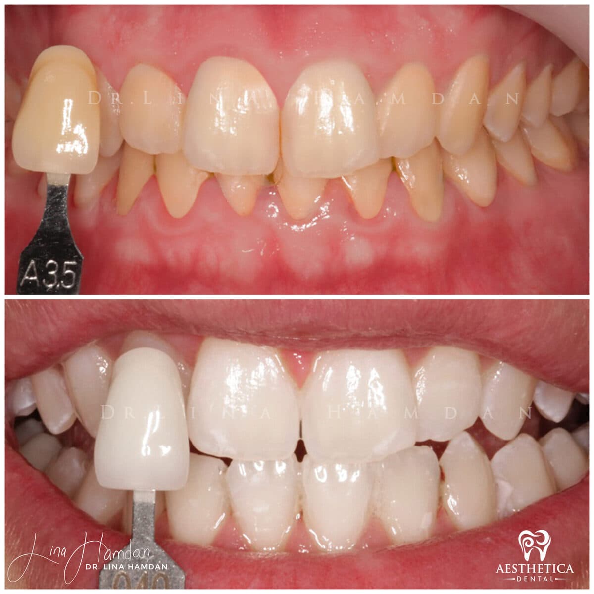 Teeth whitening case 8, anonymous patient at Aesthetica Dental Naperville, photo 2