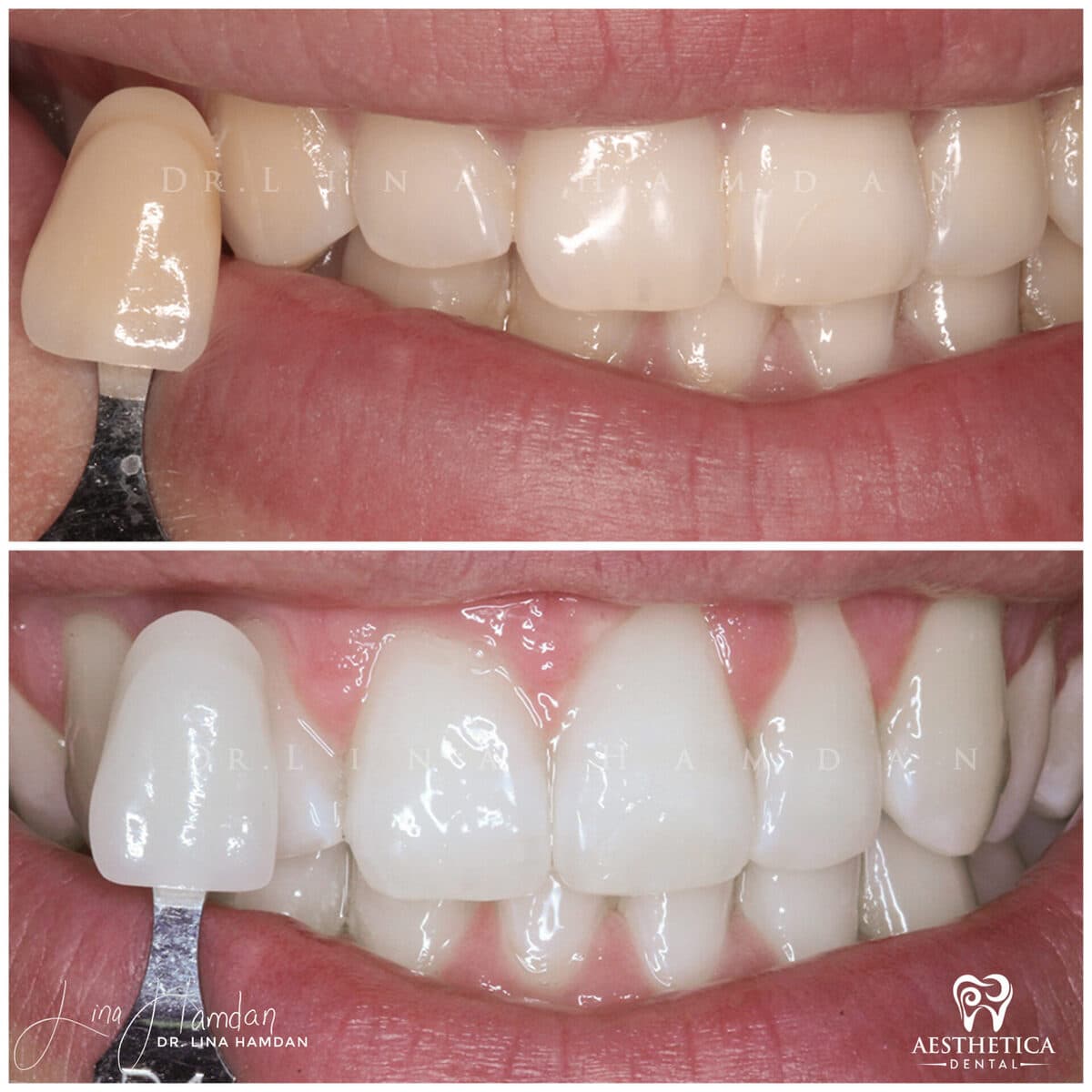 Teeth whitening case 1, anonymous patient at Aesthetica Dental Naperville, photo 2