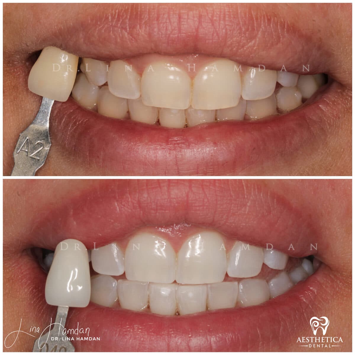Teeth whitening case 14, anonymous patient at Aesthetica Dental Naperville, photo 2