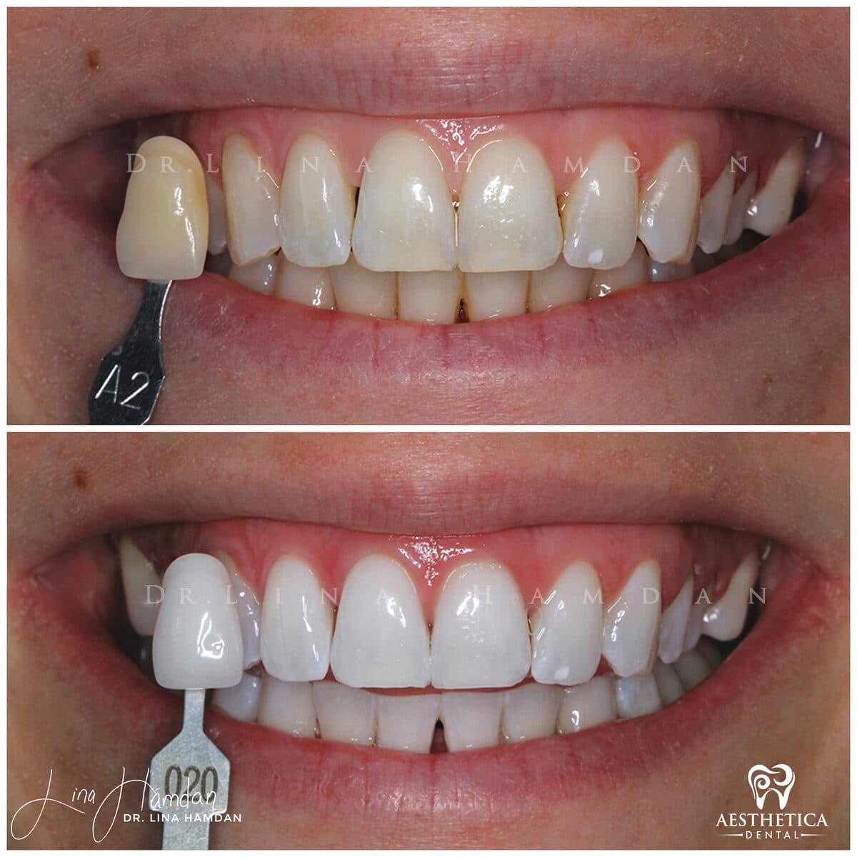Teeth whitening case 18, anonymous patient at Aesthetica Dental Naperville, photo 2