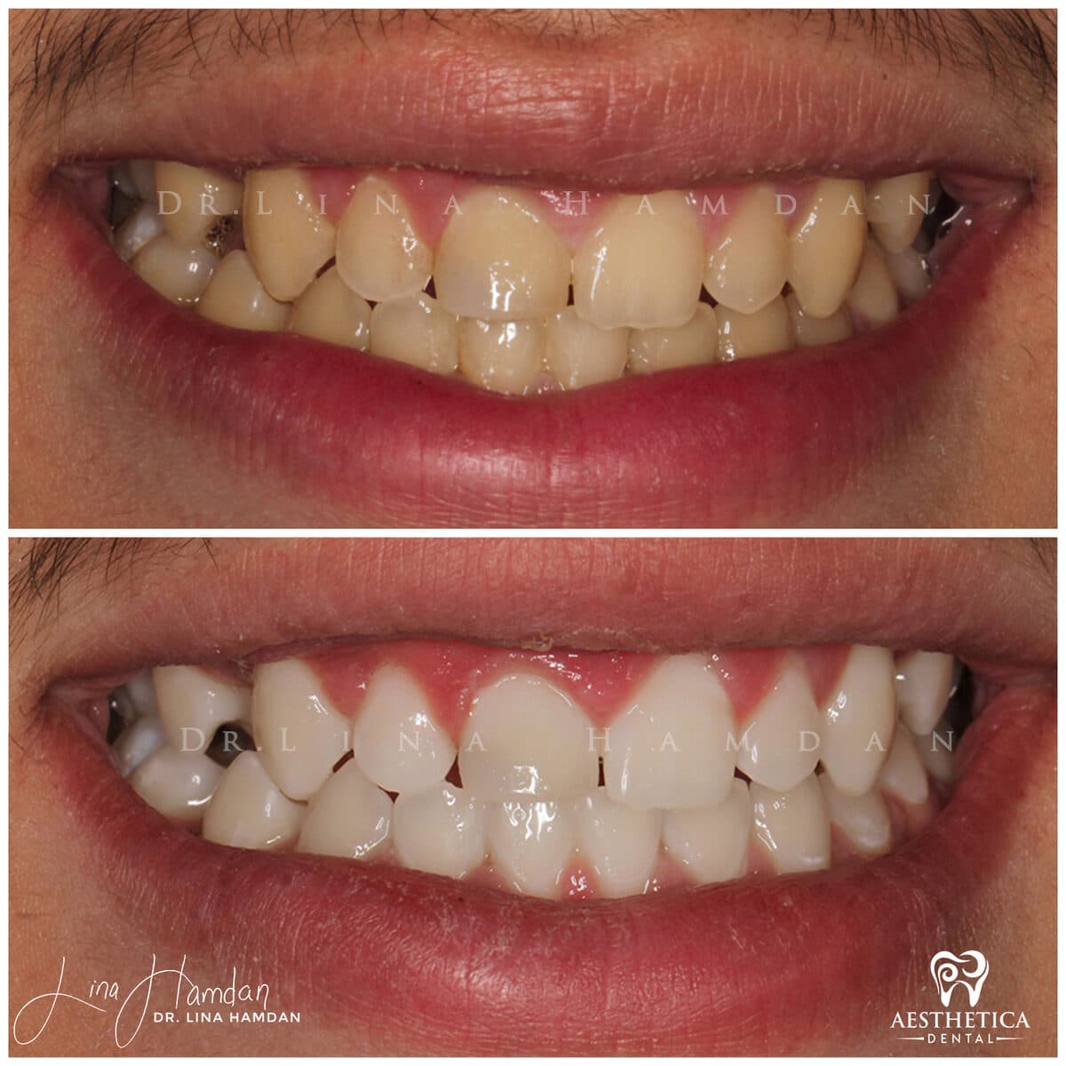 Teeth whitening case 11, anonymous patient at Aesthetica Dental Naperville, photo 2
