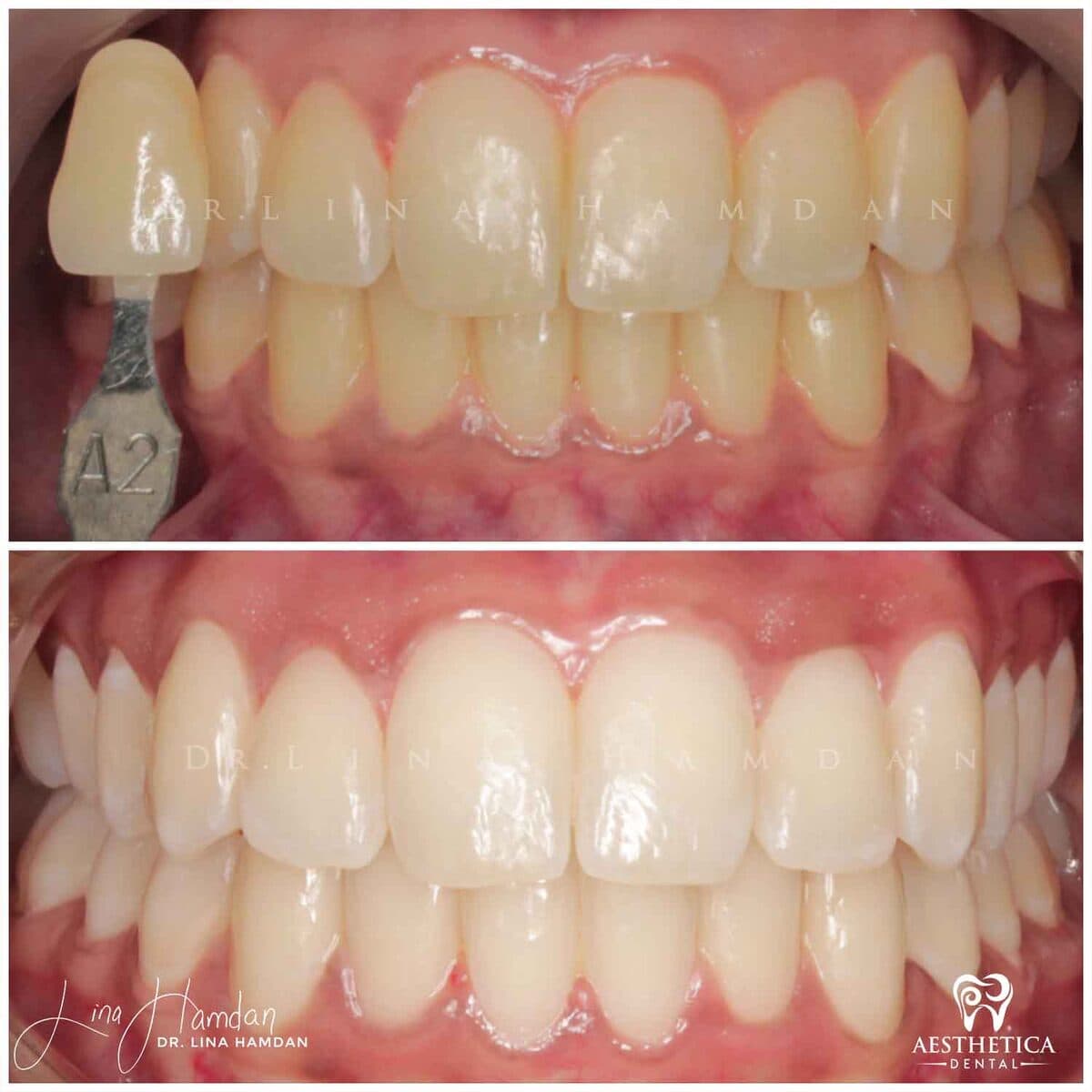 Teeth whitening case 15, anonymous patient at Aesthetica Dental Naperville, photo 2