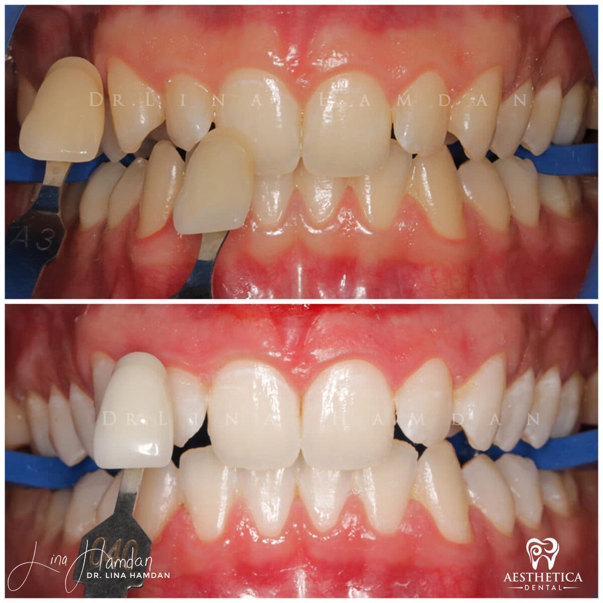 Teeth whitening case 3, anonymous patient at Aesthetica Dental Naperville, photo 2