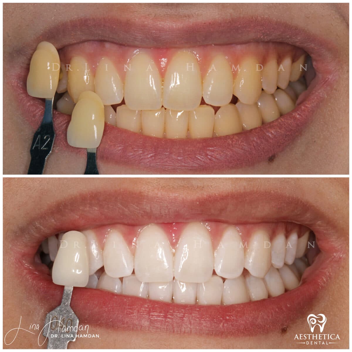 Teeth whitening case 2, anonymous patient at Aesthetica Dental Naperville, photo 3