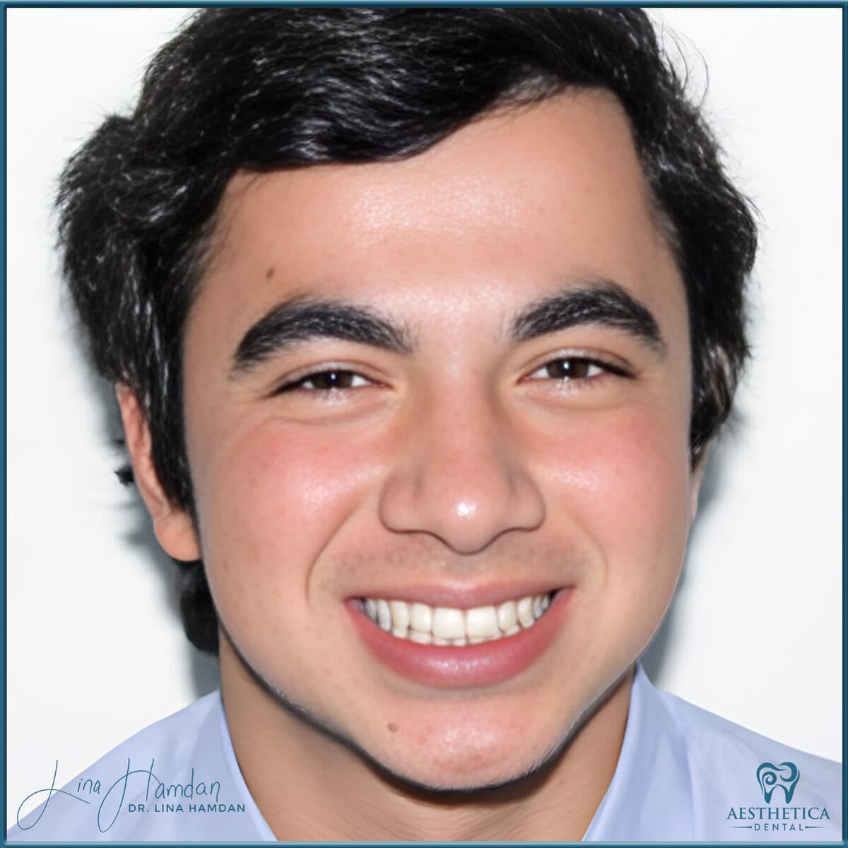 Teeth whitening case 12, anonymous patient at Aesthetica Dental Naperville, photo 1