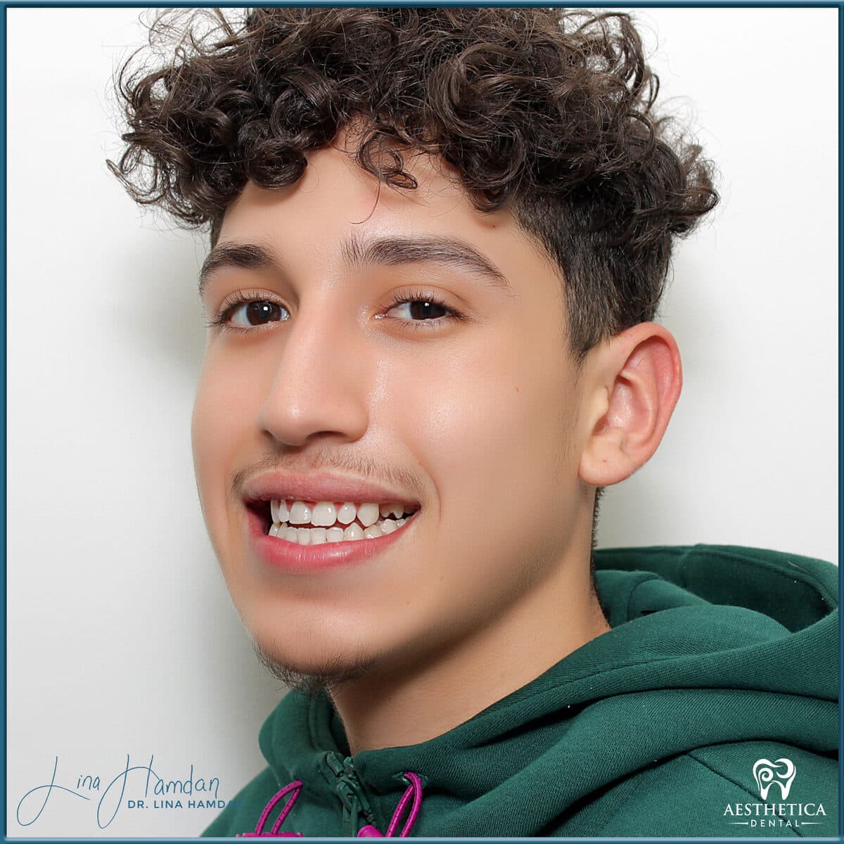 Teeth whitening case 11, anonymous patient at Aesthetica Dental Naperville, photo 1