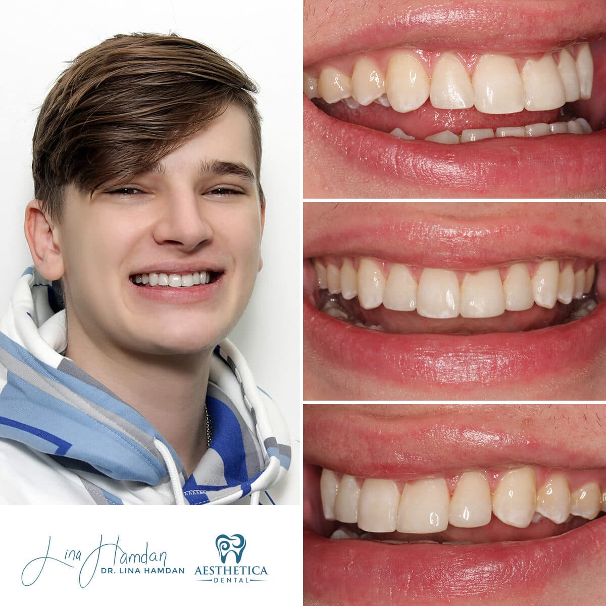 Teeth whitening case 6, anonymous patient at Aesthetica Dental Naperville, photo 2