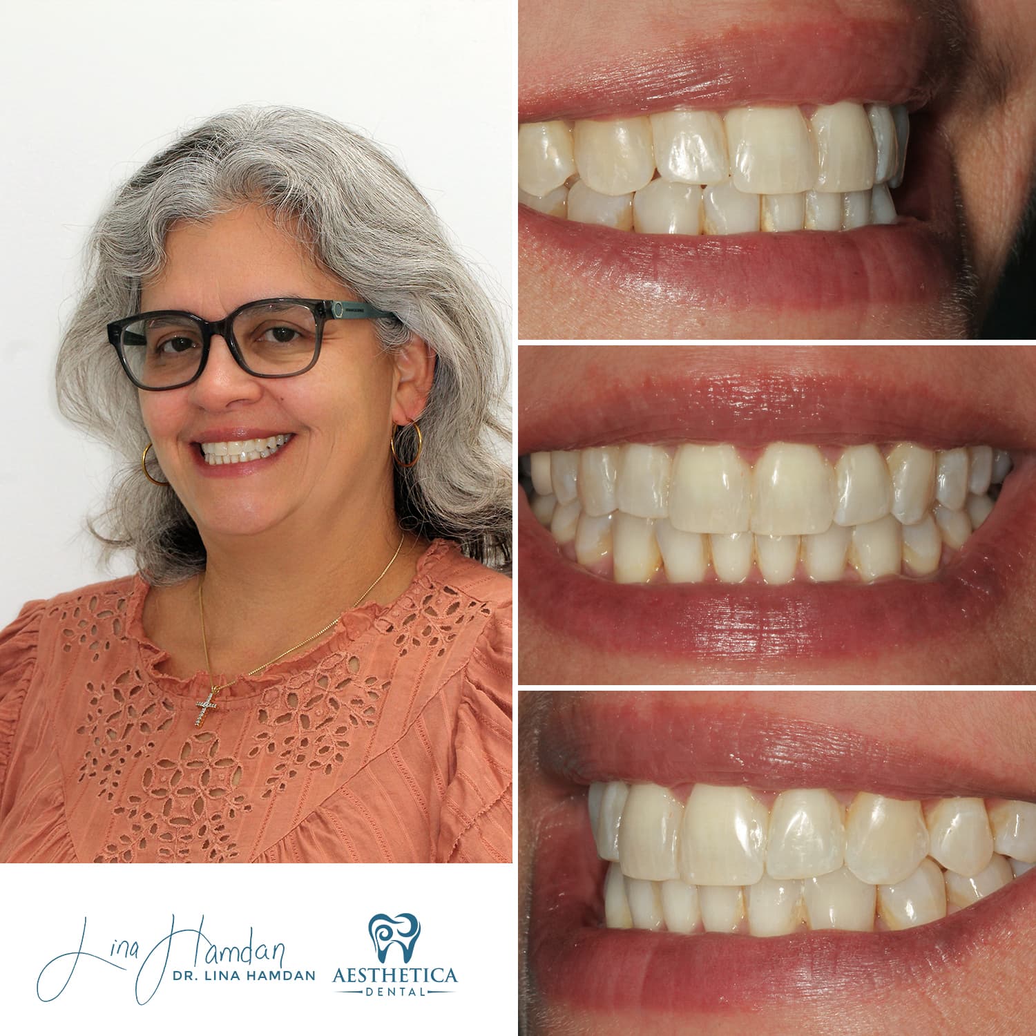 Beauty Injections: patient result by Dr. Lina Hamdan