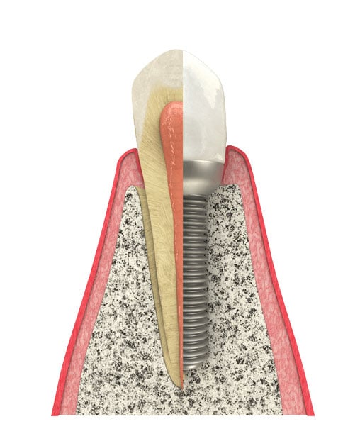 Benefits of Dental Implants in Naperville, IL