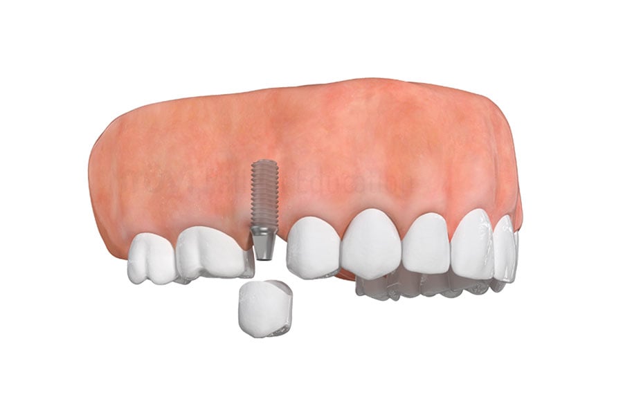 Dental Implant in Naperville, IL
