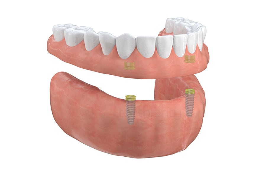 Implant-Supported Overdentures in Naperville, IL