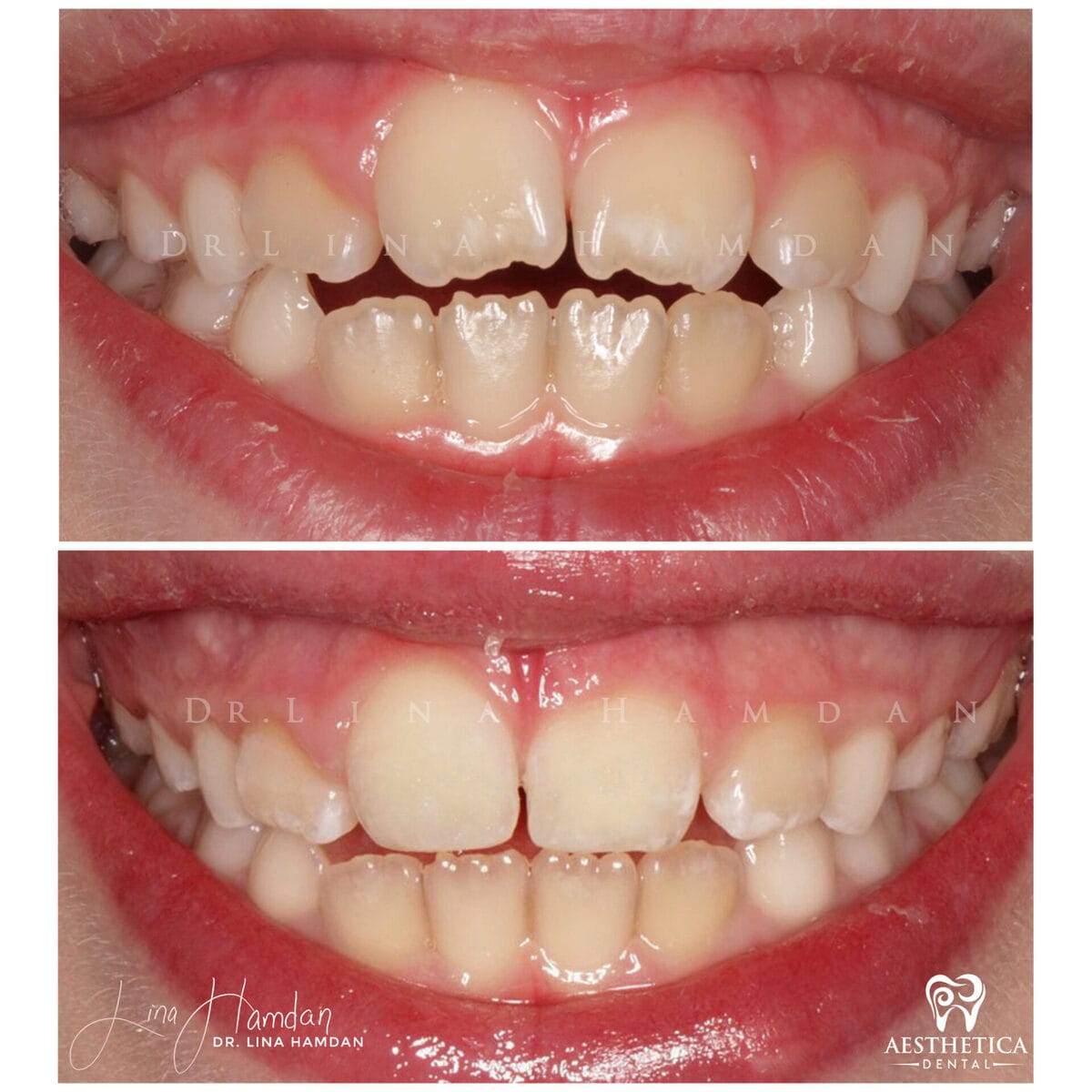 Composite bonding: anonymous case 13 from Aesthetica Dental Naperville