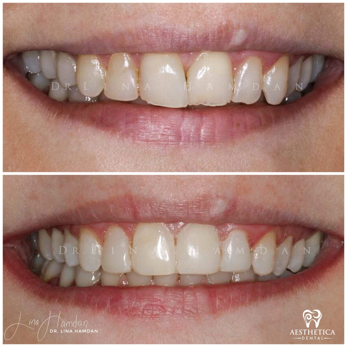 Composite bonding: anonymous case 17 from Aesthetica Dental Naperville