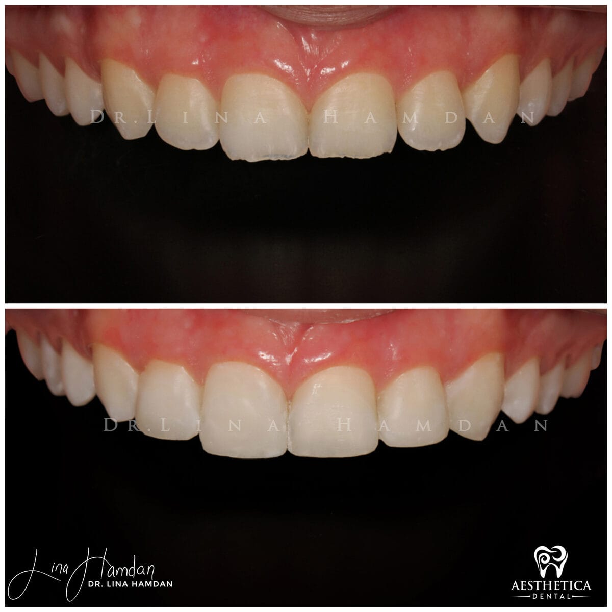 Composite bonding: anonymous case 26 from Aesthetica Dental Naperville
