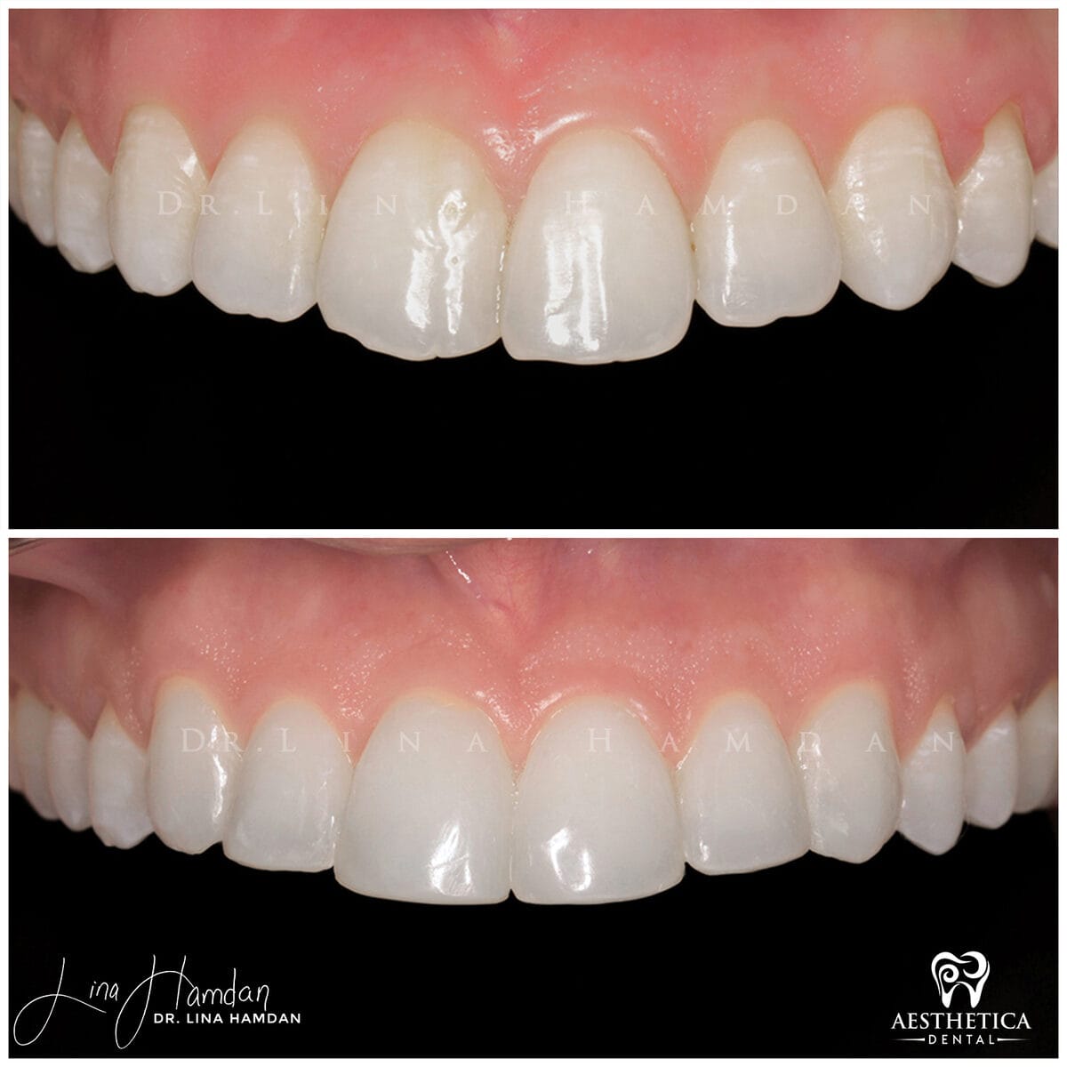 Composite bonding: anonymous case 30 from Aesthetica Dental Naperville