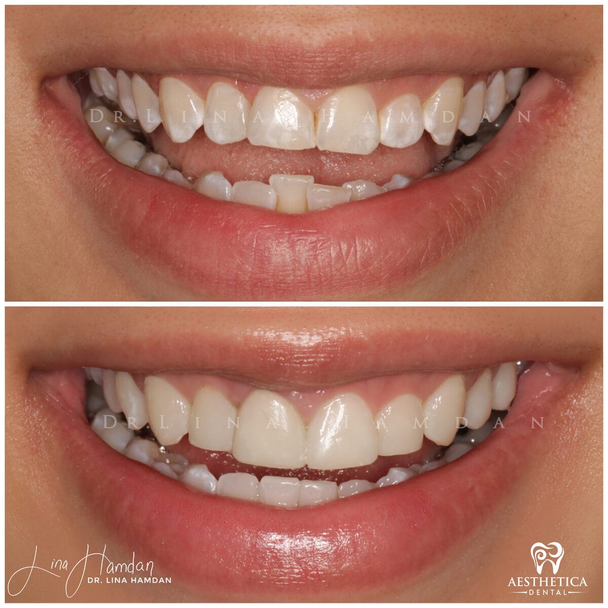 Composite bonding: anonymous case 32 from Aesthetica Dental Naperville